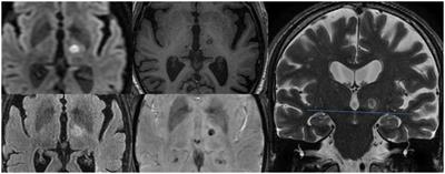 Early re-emerging tremor after MRgFUS thalamotomy: case–control analysis of procedural and imaging features